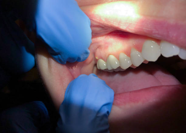 Best Emergency Dental Care for Broken or Chipped Teeth in Northampton, MA